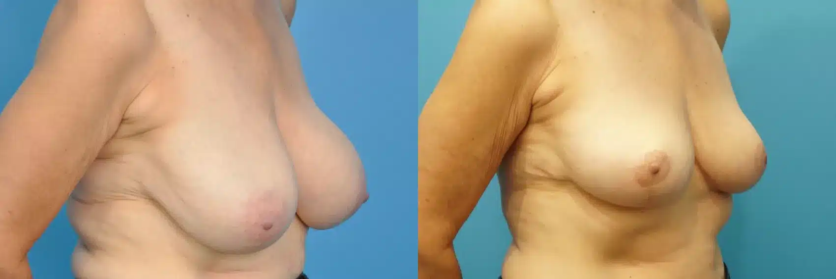 Before and After Image: Case #261 - right-front-oblique