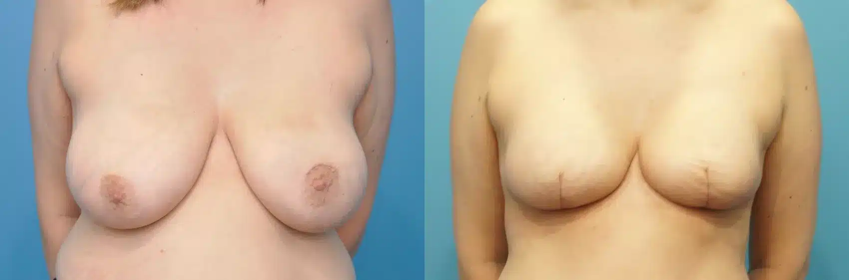 Before and After Image: Case #264 - front