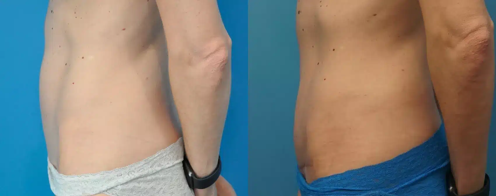 Before and After Image: Case #265 - left-side