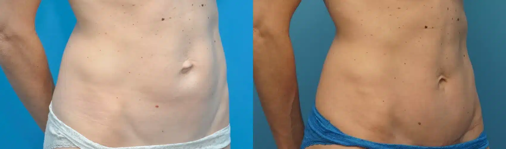 Before and After Image: Case #265 - right-front-oblique