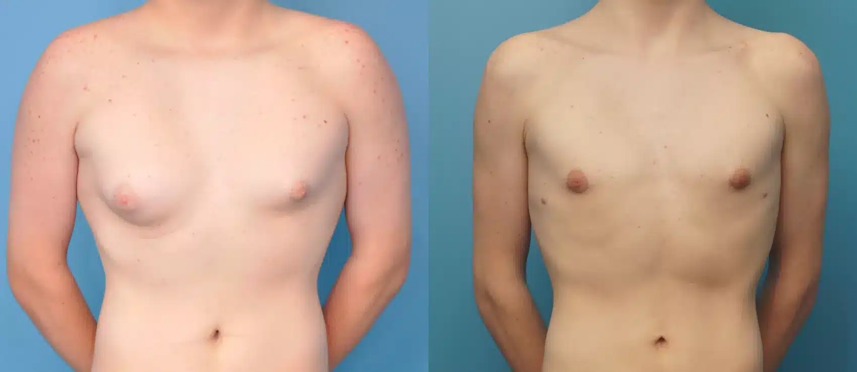 Before and After Image: Case #272 - front