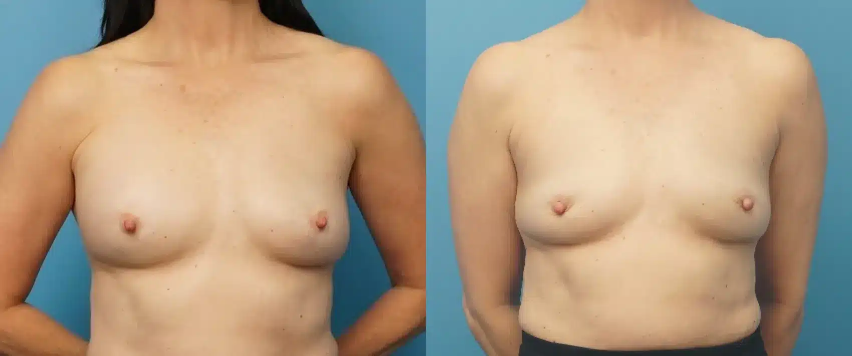 Before and After Image: Awake Breast Implant Removal - front