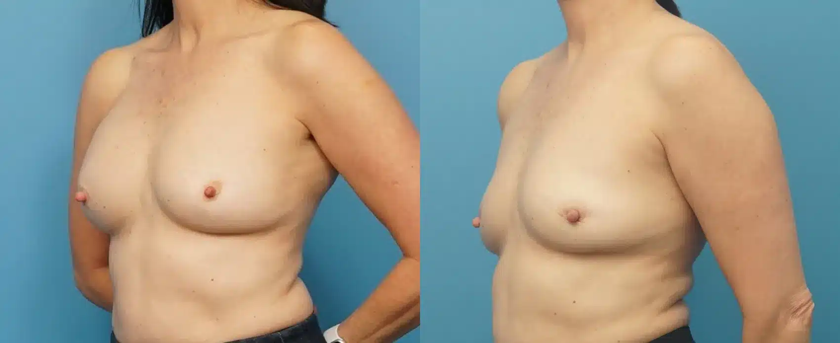 Before and After Image: Awake Breast Implant Removal - left-front-oblique