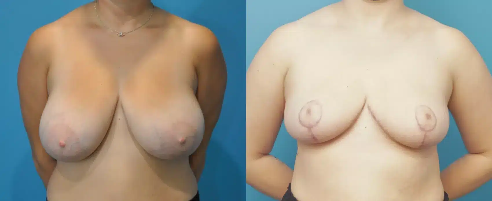 Before and After Image: Case #274 - front
