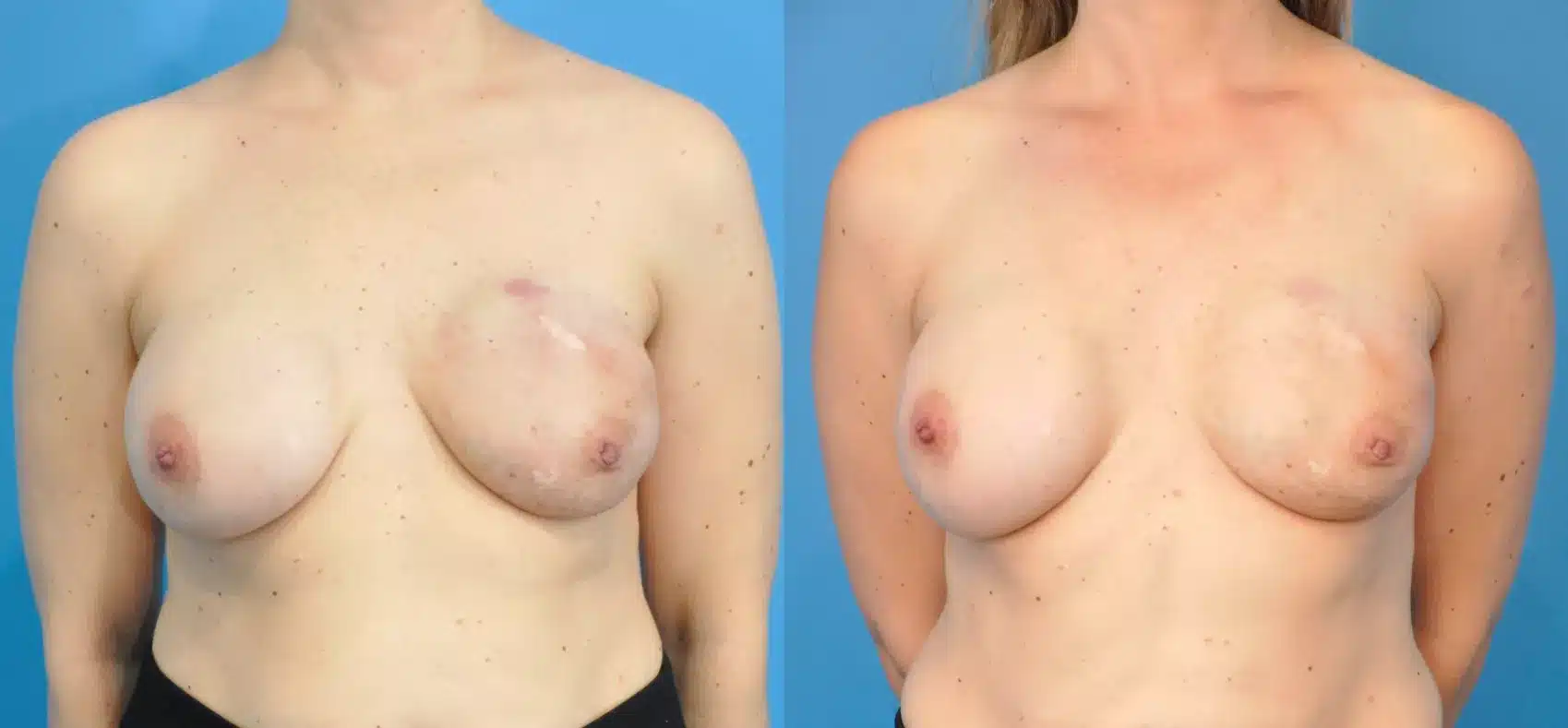 Before and After Image: Case #275 - front