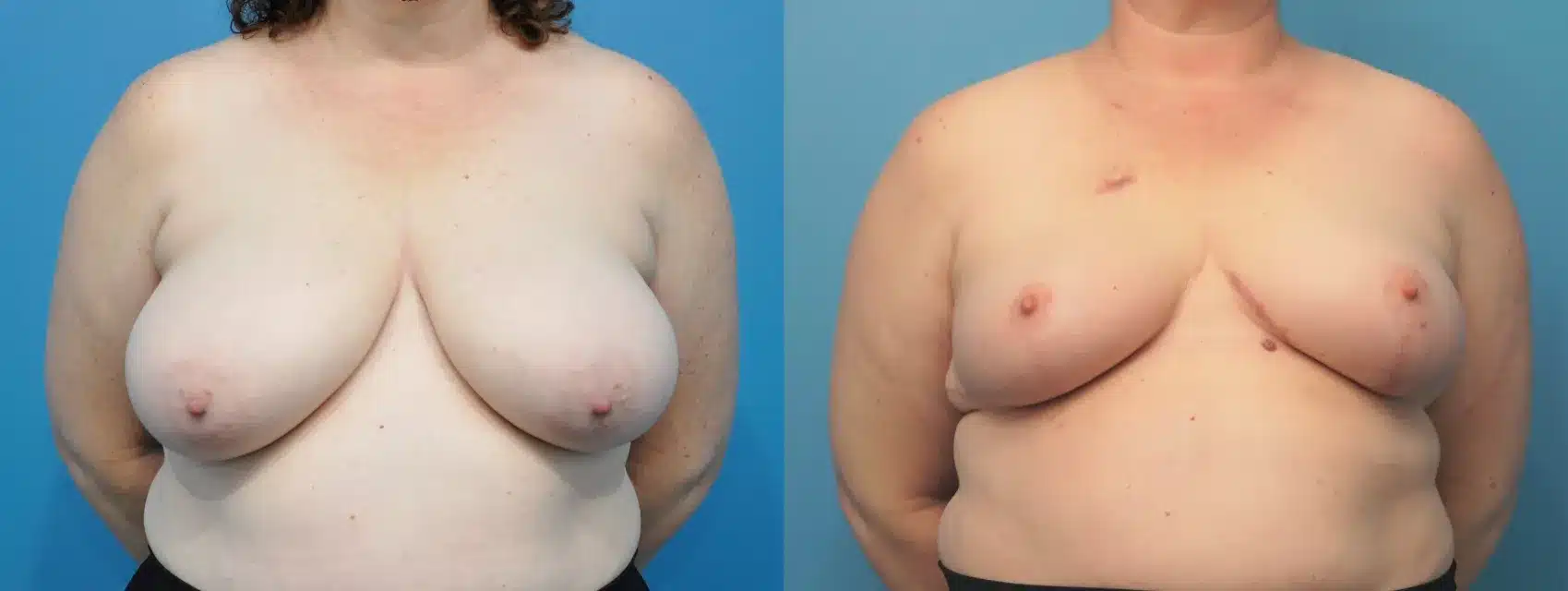 Before and After Image: Mastectomy Reconstruction with Implants - front
