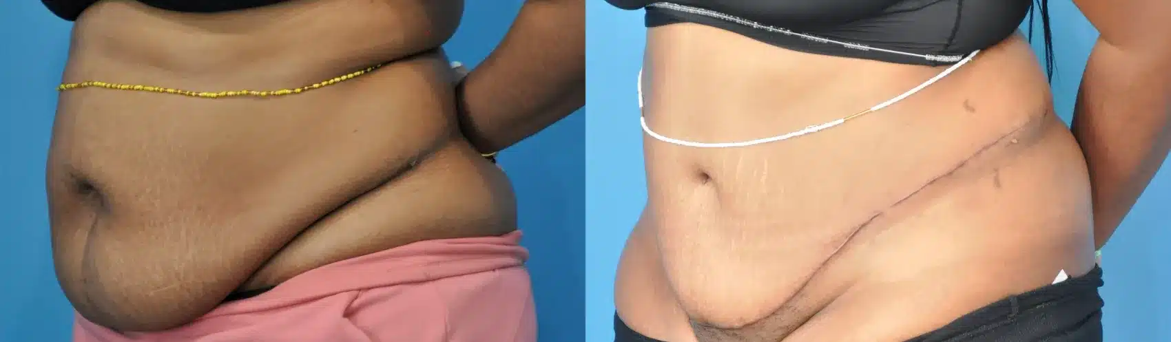 Before and After Image: Case #277 - left-front-oblique