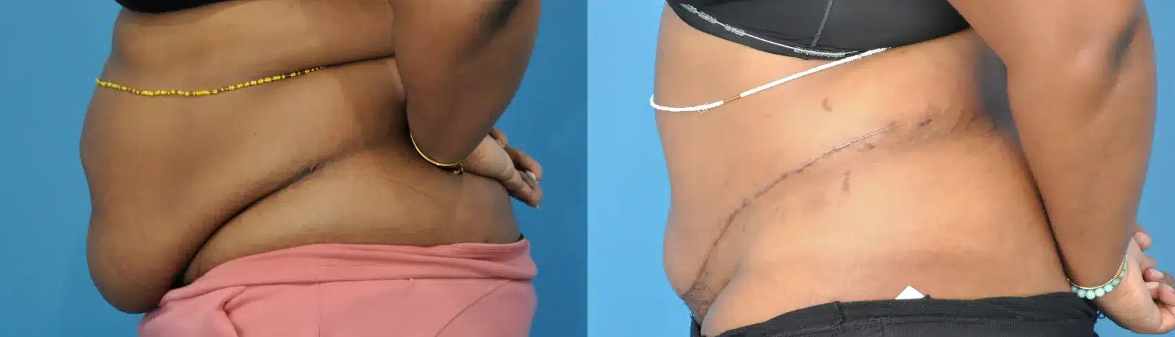 Before and After Image: Case #277 - left-side