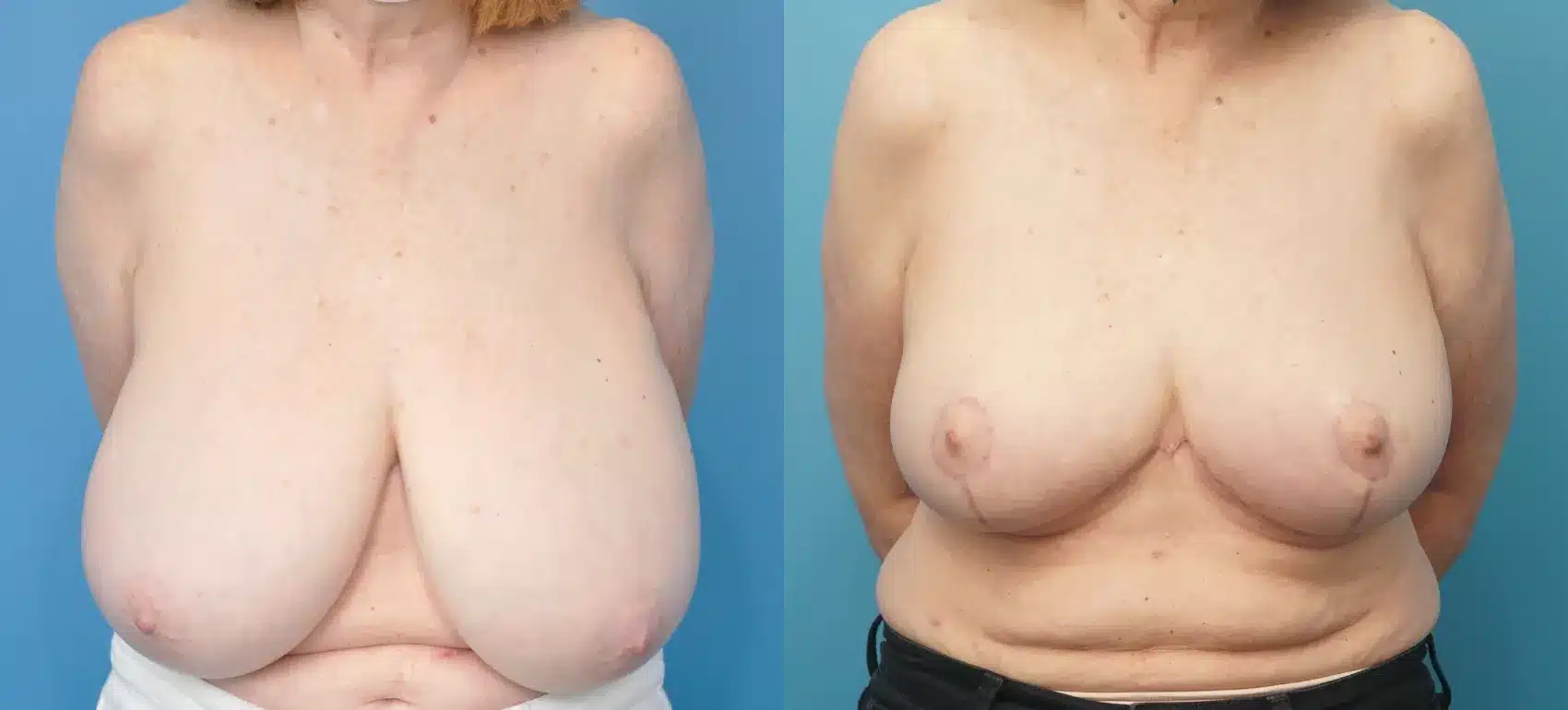 Before and After Image: Case #278 - front