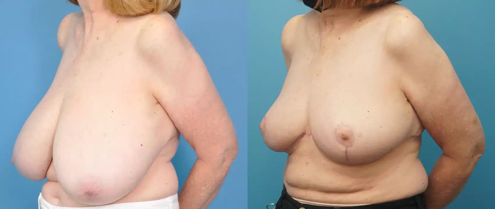 Before and After Image: Case #278 - left-front-oblique