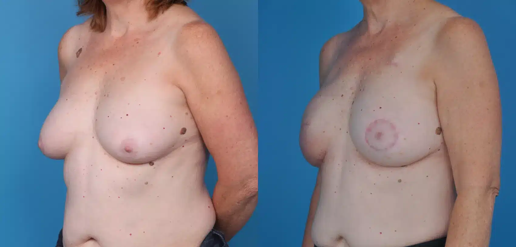 Before and After Image: Case #28 - left-front-oblique