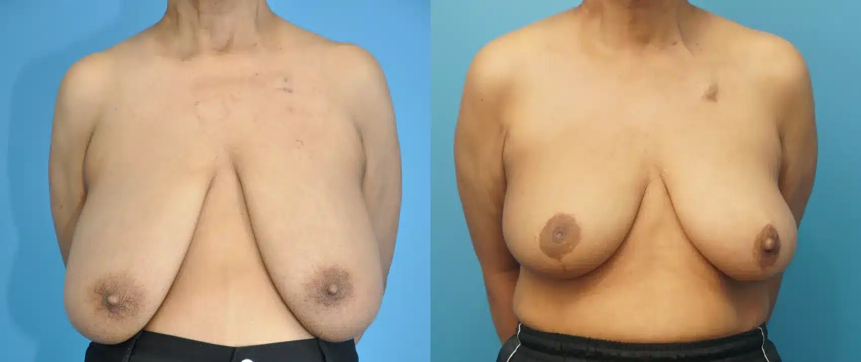 Before and After Image: Oncoplastic Reduction and Lift for Breast Cancer - front