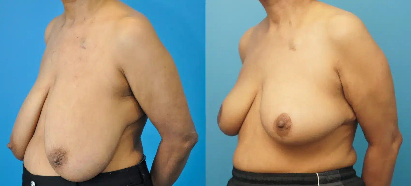 Before and After Image: Oncoplastic Reduction and Lift for Breast Cancer - left-front-oblique