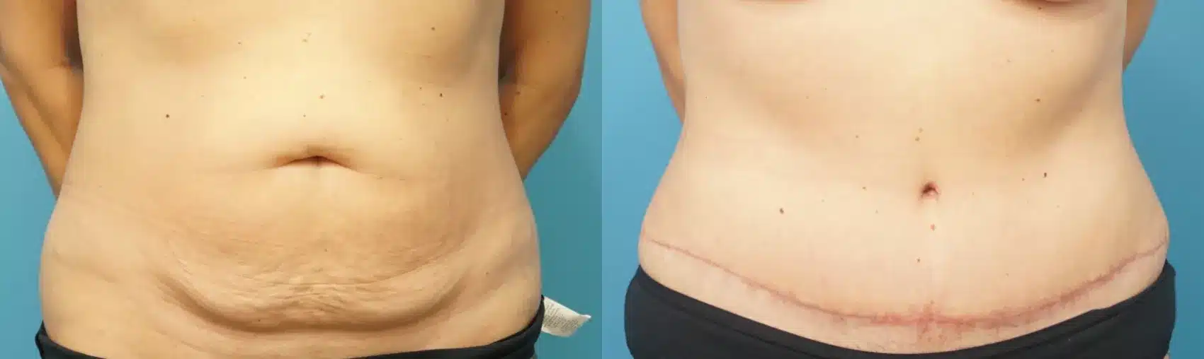 Before and After Image: Case #281 - front