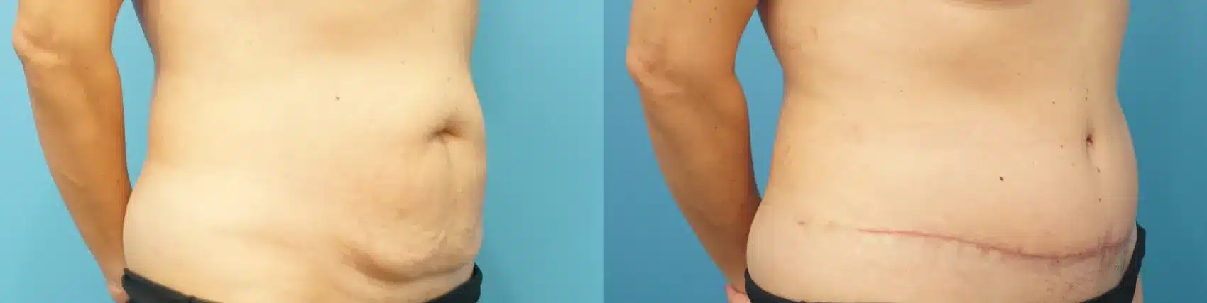 Before and After Image: Case #281 - right-front-oblique