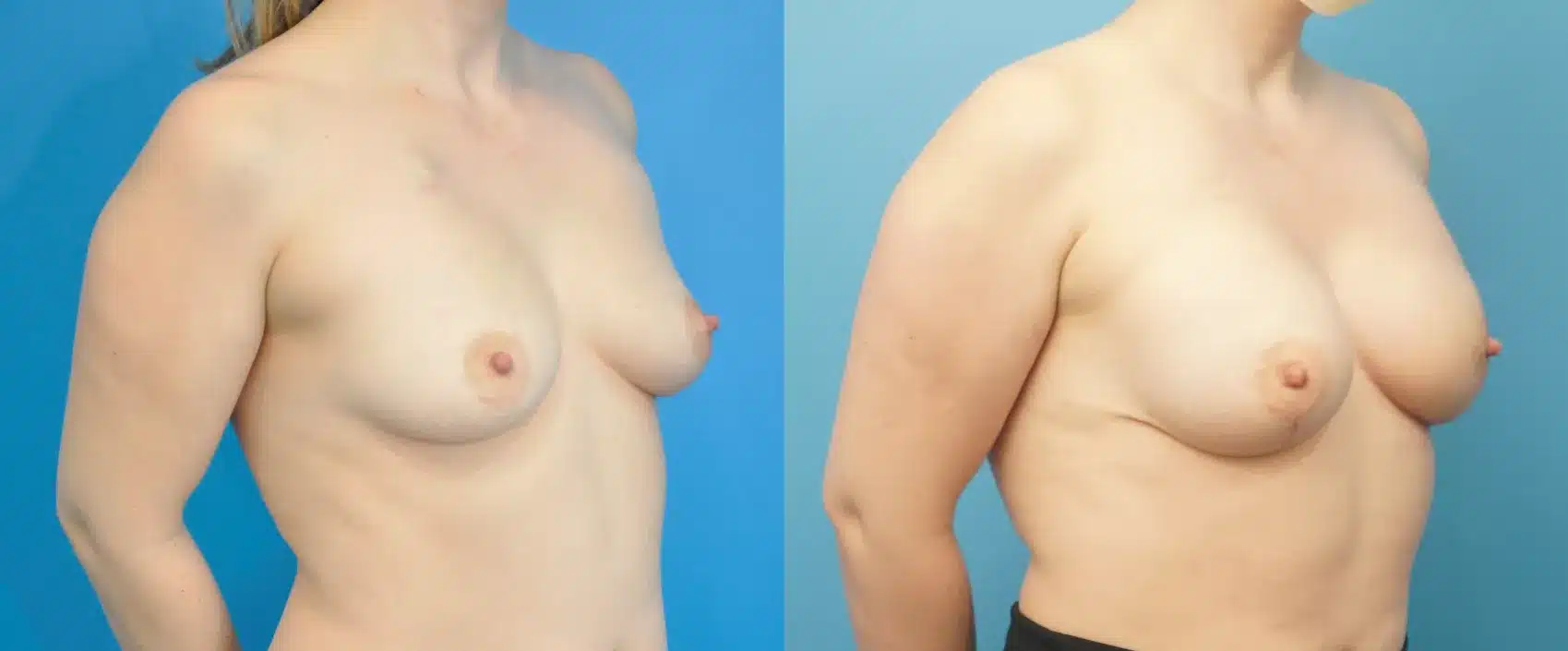 Before and After Image: Case #282 - right-front-oblique