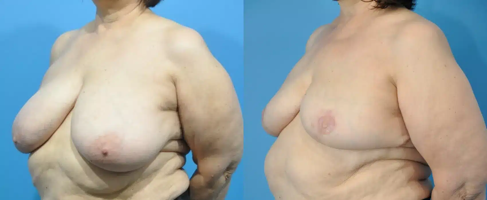 Before and After Image: Case #283 - left-front-oblique