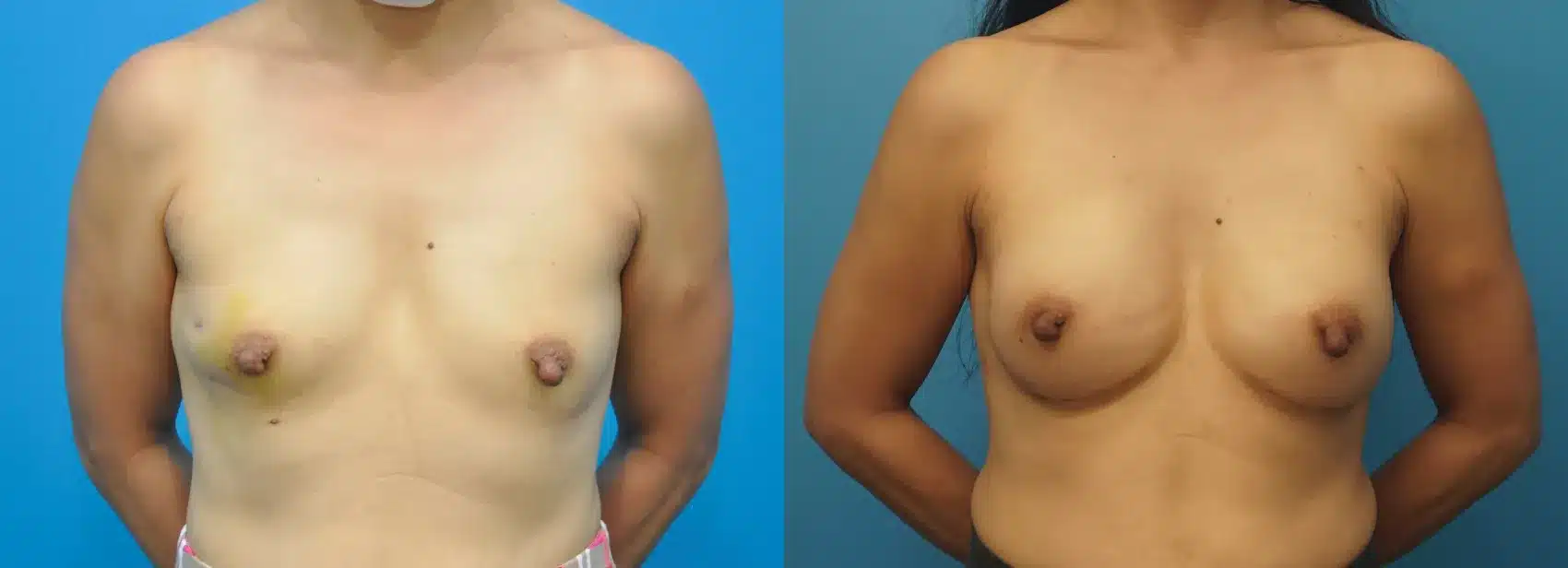 Before and After Image: Case #285 - front