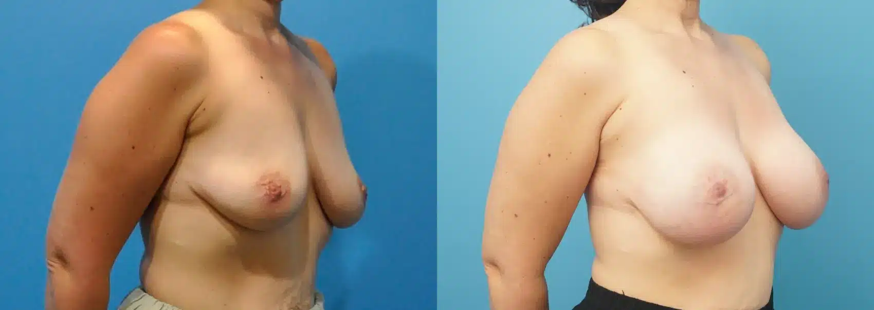 Before and After Image: Case #286 - right-front-oblique