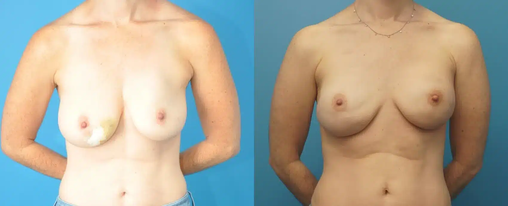 Before and After Image: Case #287 - front