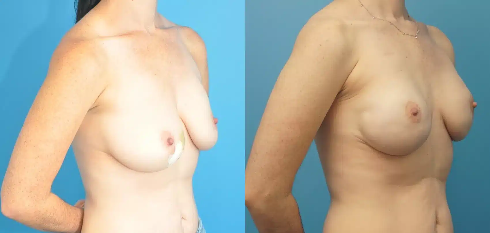 Before and After Image: Case #287 - right-front-oblique