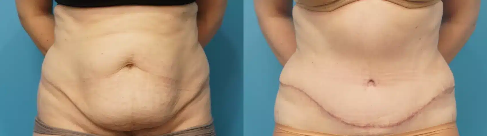 Before and After Image: Case #288 - front