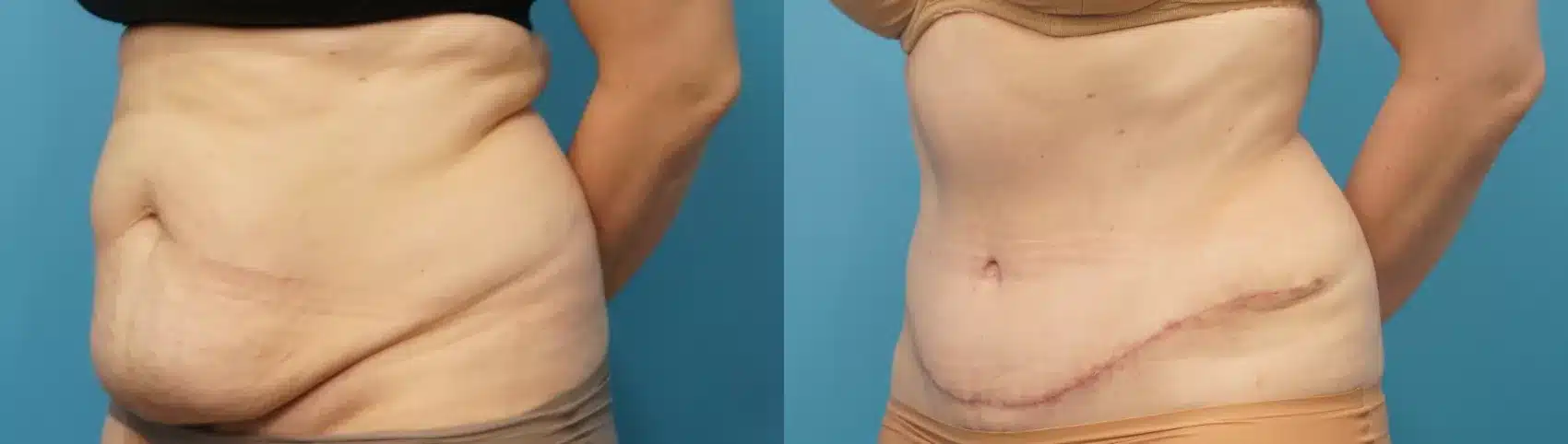 Before and After Image: Case #288 - left-front-oblique