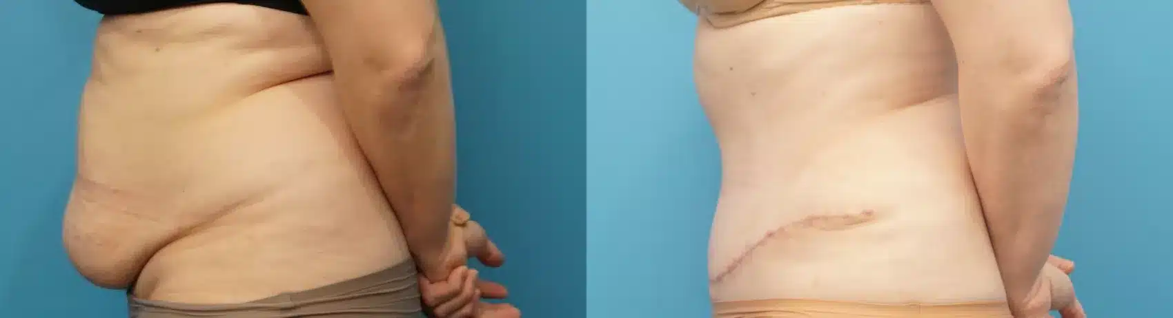 Before and After Image: Case #288 - left-side