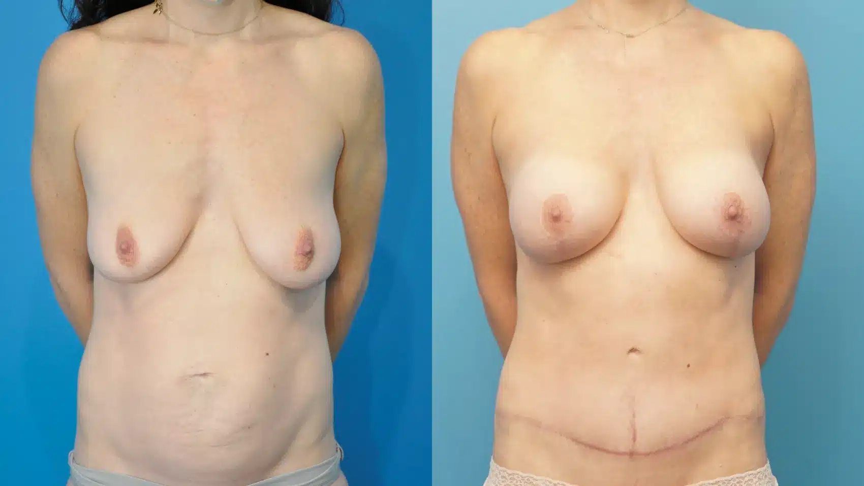 Before and After Image: Breast Augmentation with Lift and Abdominoplasty