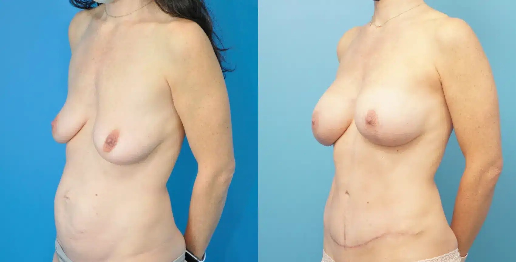 Before and After Image: Breast Augmentation with Lift and Abdominoplasty - left-front-oblique