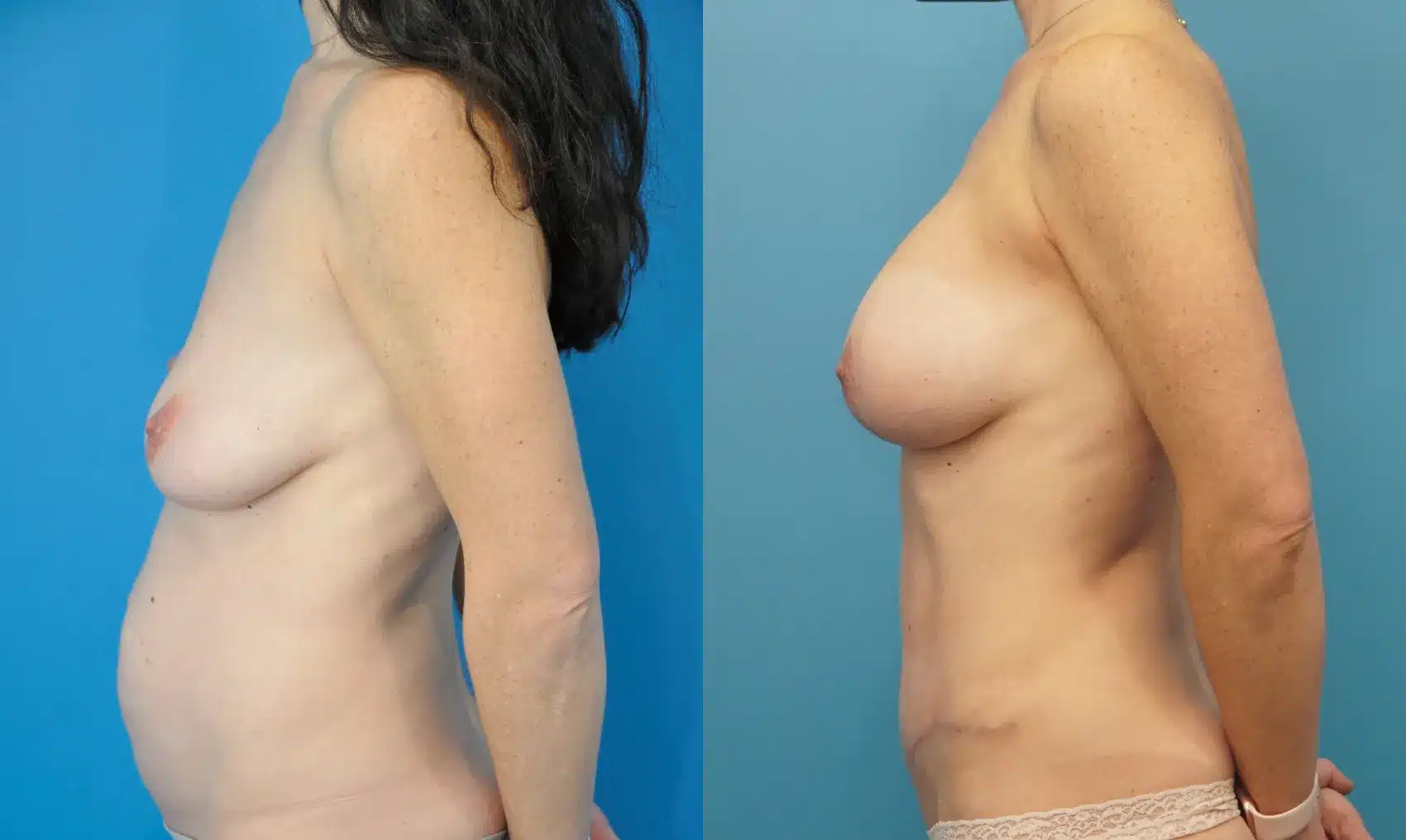 Before and After Image: Breast Augmentation with Lift and Abdominoplasty - left-side