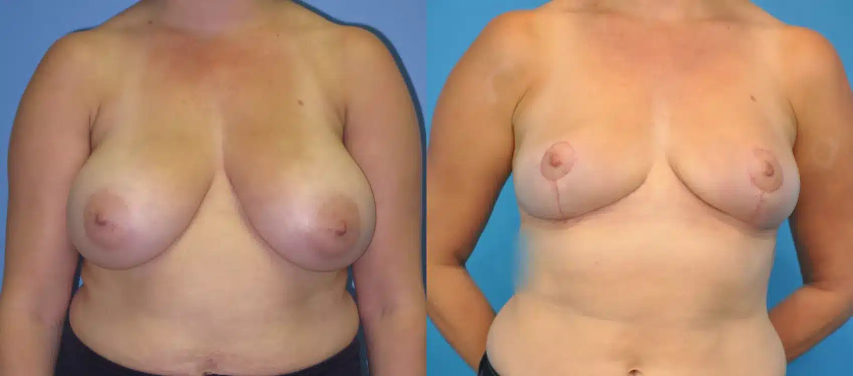 Before and After Image: Case #29 - front