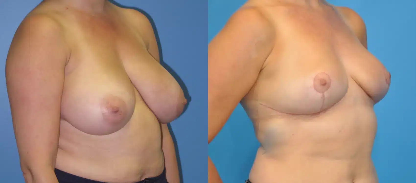 Before and After Image: Case #29 - right-front-oblique