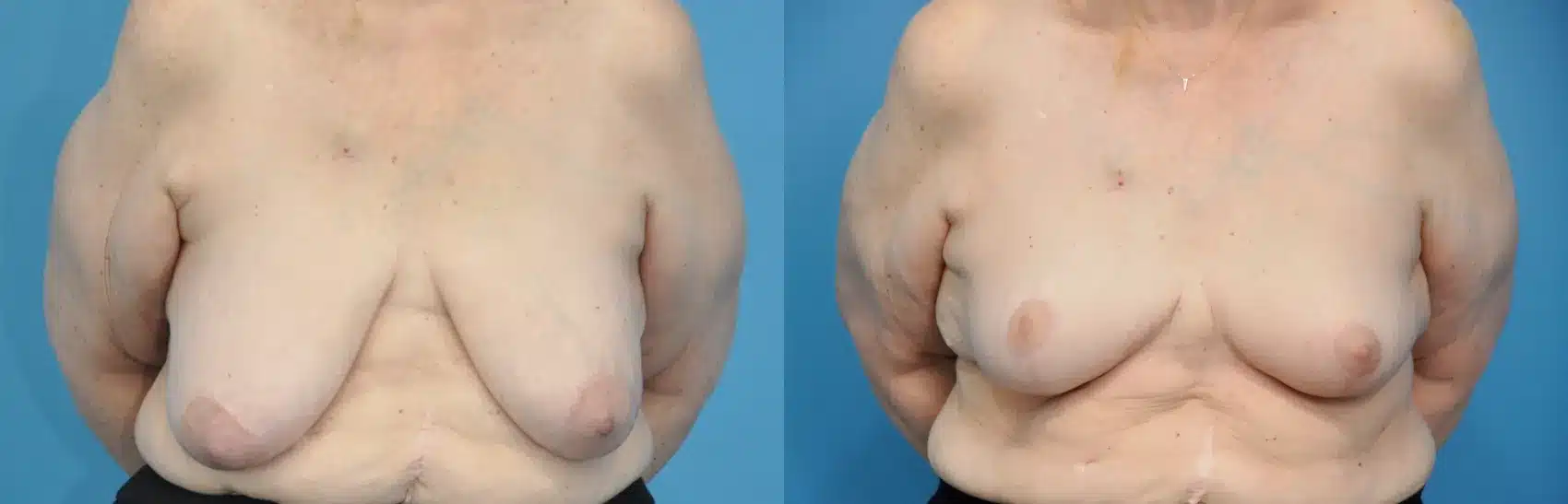 Before and After Image: Oncoplastic Reduction and Lift for Breast Cancer - front