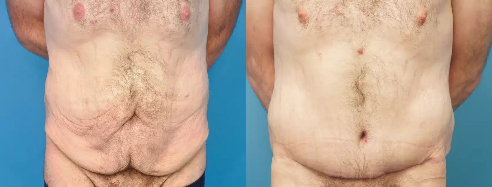 Before and After Image: Case #291 - front