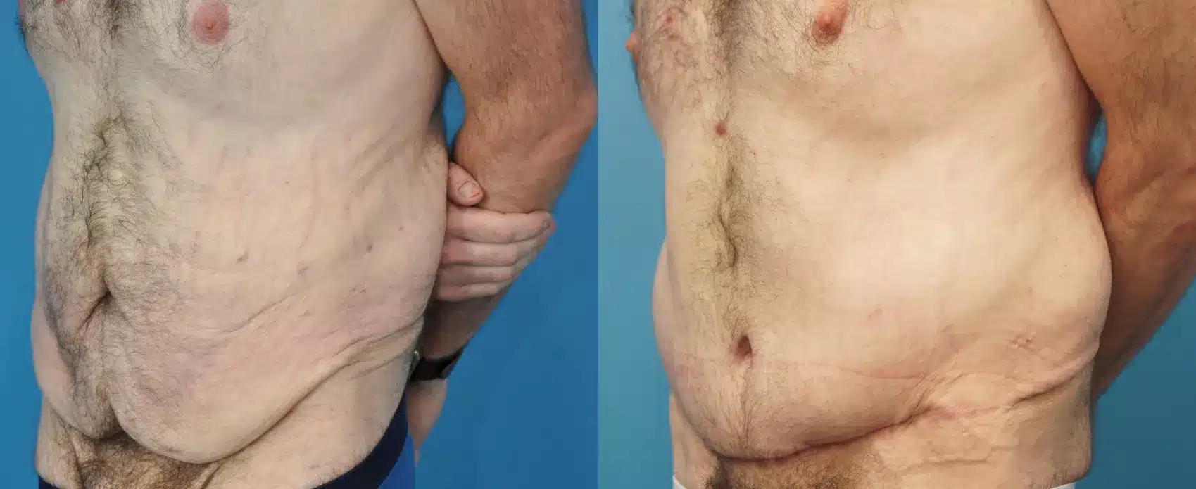 Before and After Image: Case #291 - left-front-oblique
