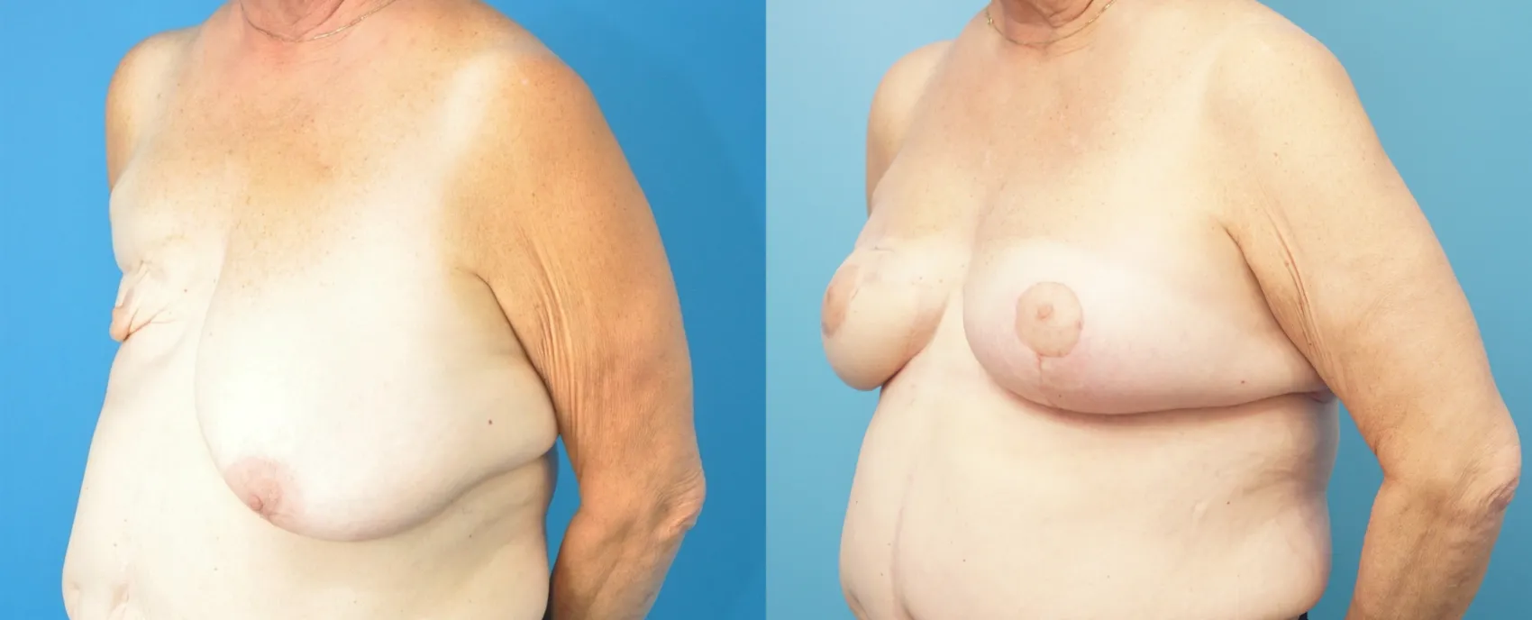 Before and After Image: Revision Breast Reconstruction with Latissumus Flap - left-front-oblique
