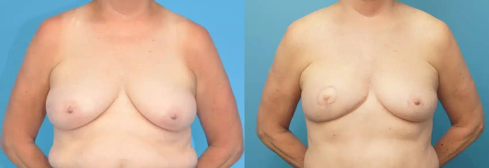 Before and After Image: Case #295 - front