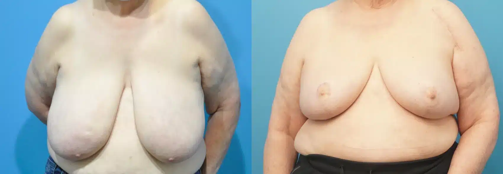 Before and After Image: Case #296 - front