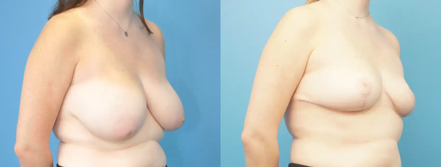 Before and After Image: Breast Reduction and Lift - right-front-oblique