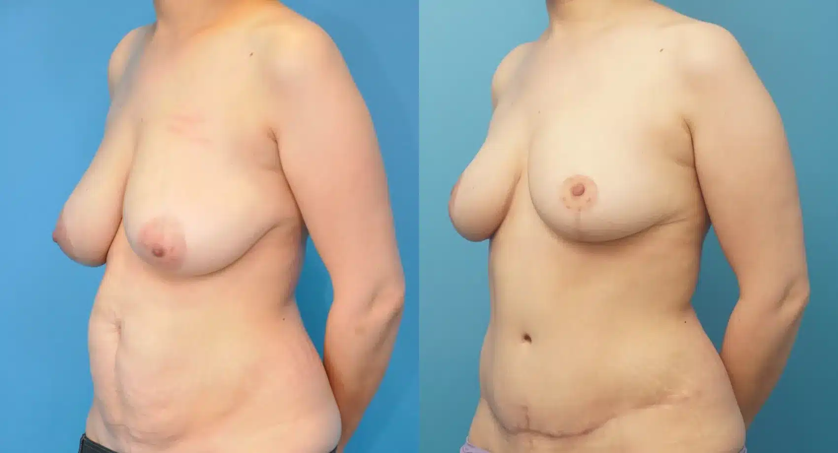 Before and After Image: Breast Lift/Reduction and Tummy Tuck - left-front-oblique