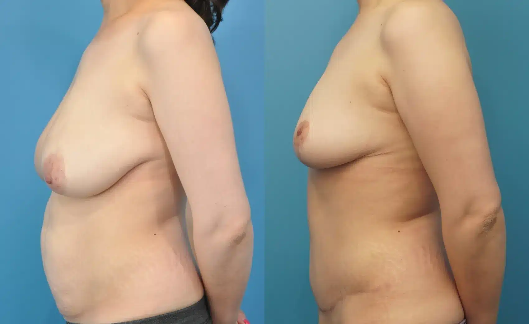 Before and After Image: Breast Lift/Reduction and Tummy Tuck - left-side