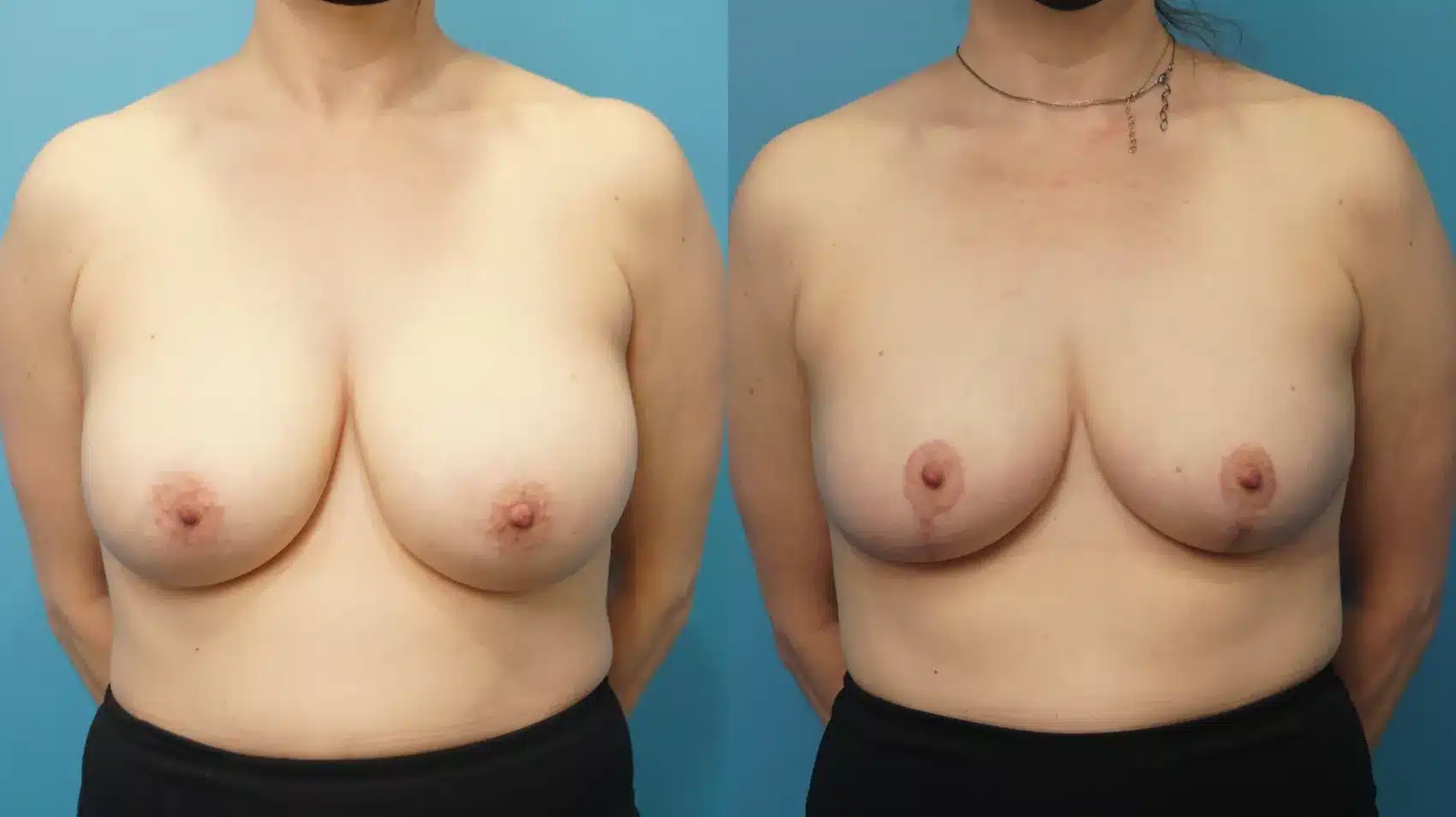 Before and After Image: Case #300 - front