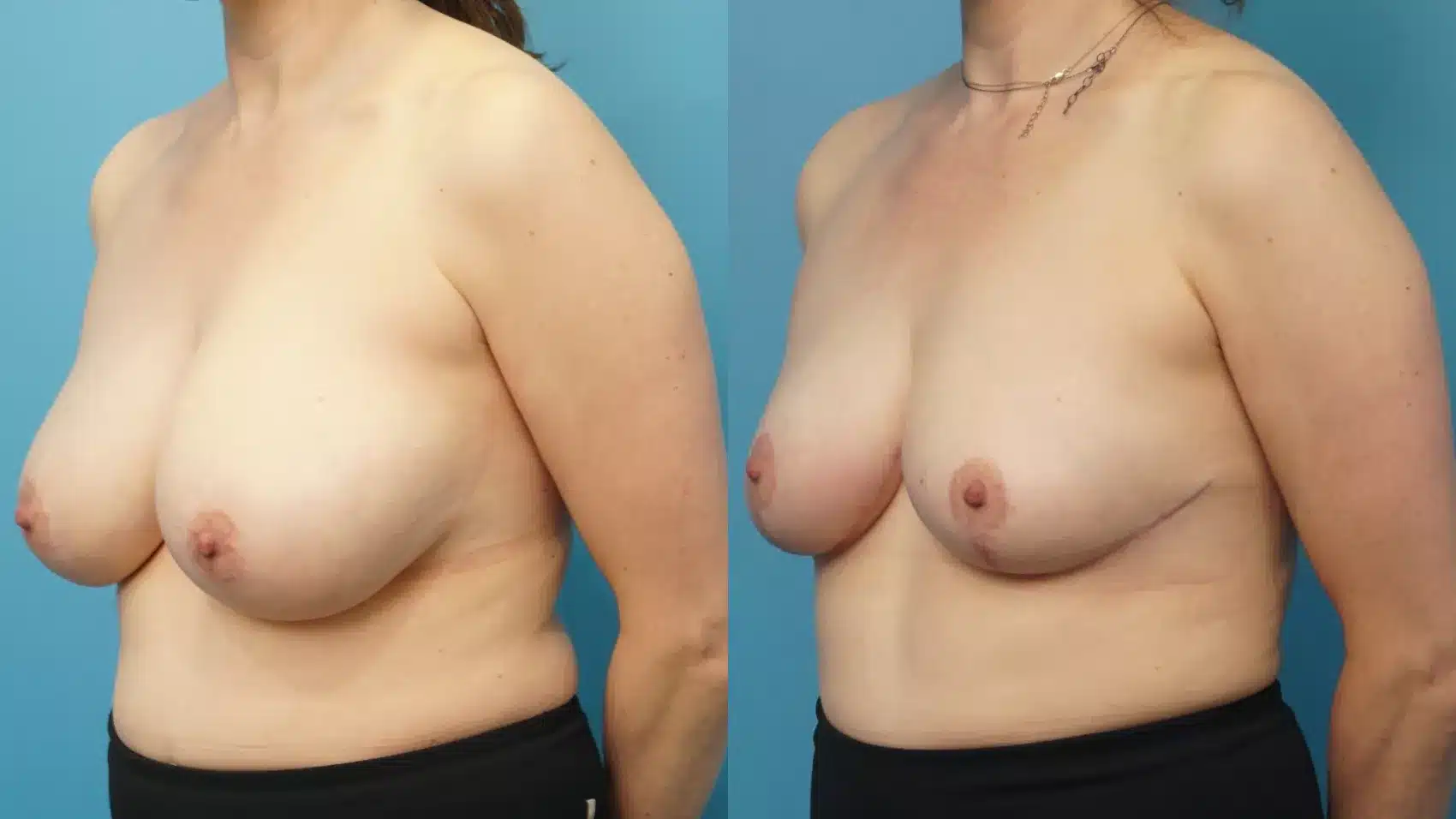 Before and After Image: Case #300 - left-front-oblique