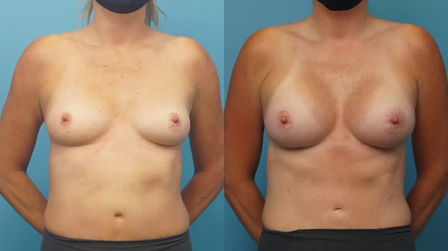 Before and After Image: Case #301 - front
