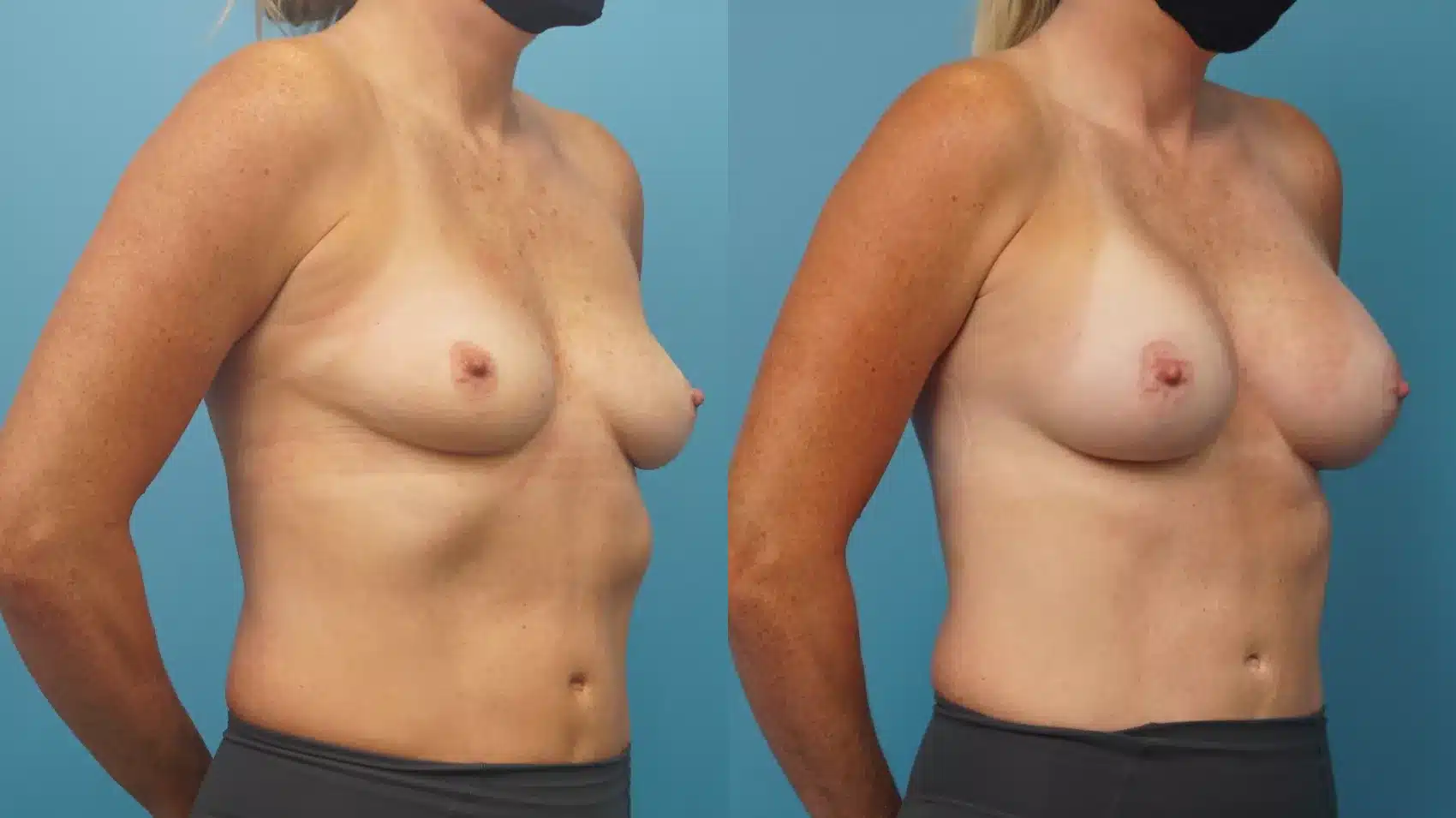 Before and After Image: Case #301 - right-front-oblique