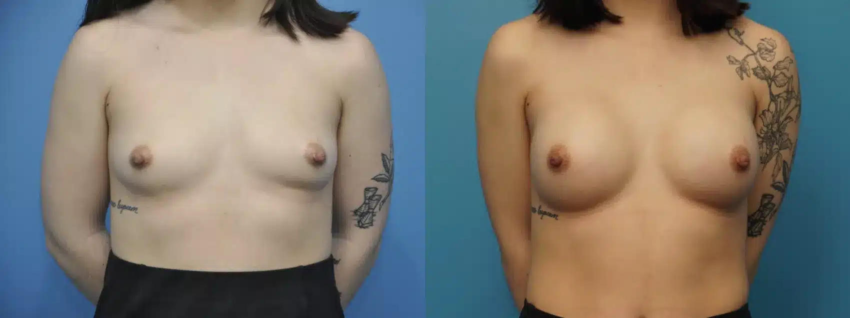 Before and After Image: Case #302 - front