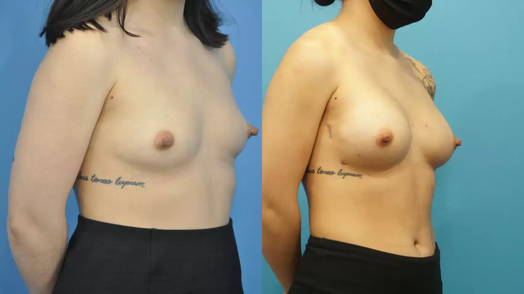 Before and After Image: Case #302 - right-front-oblique