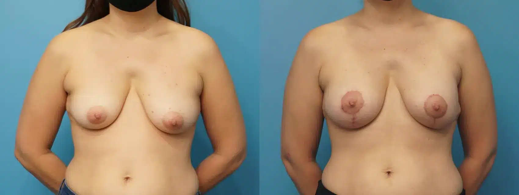 Before and After Image: Case #303 - front