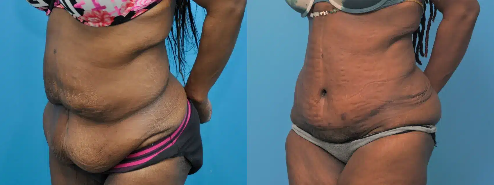 Before and After Image: Case #305 - left-front-oblique